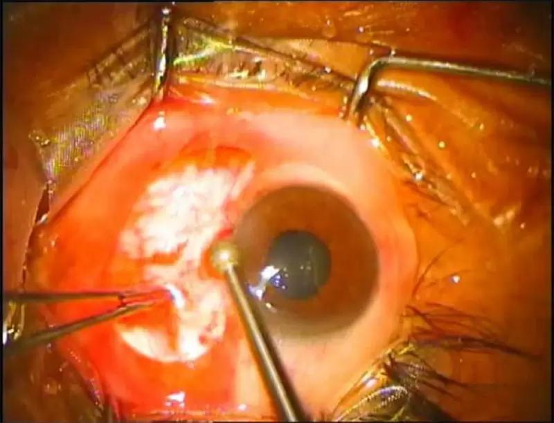 مدت زمان استراحت بعد از عمل ناخنک چشم باشه
